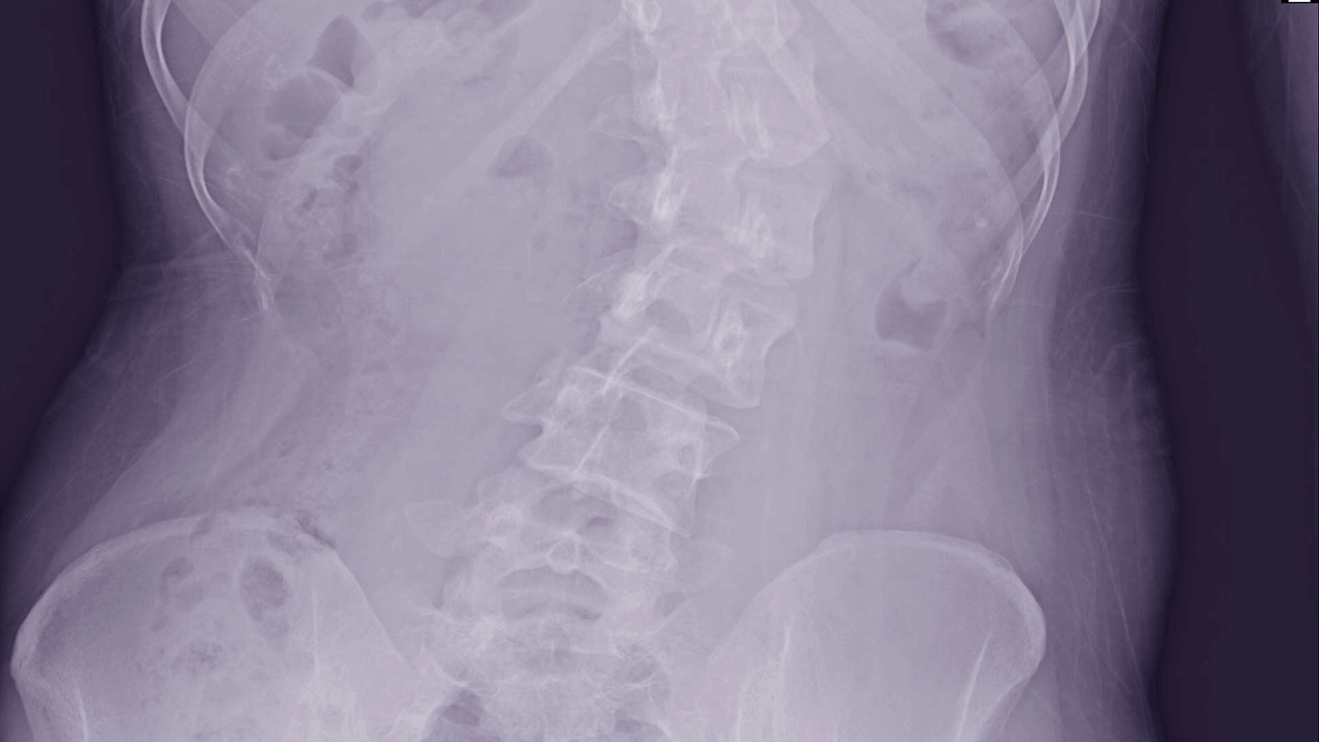 Why Schools Should Be Screening Children for Scoliosis