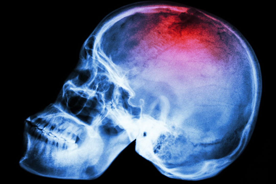 head injuries in playgrounds