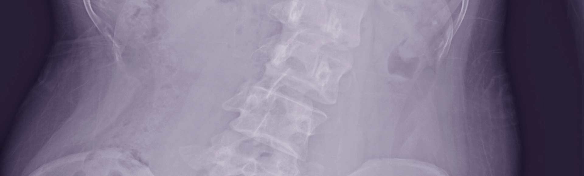 Why Schools Should Be Screening Children for Scoliosis