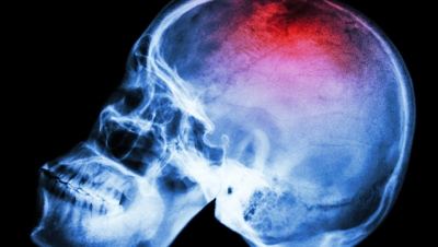 head injuries in playgrounds